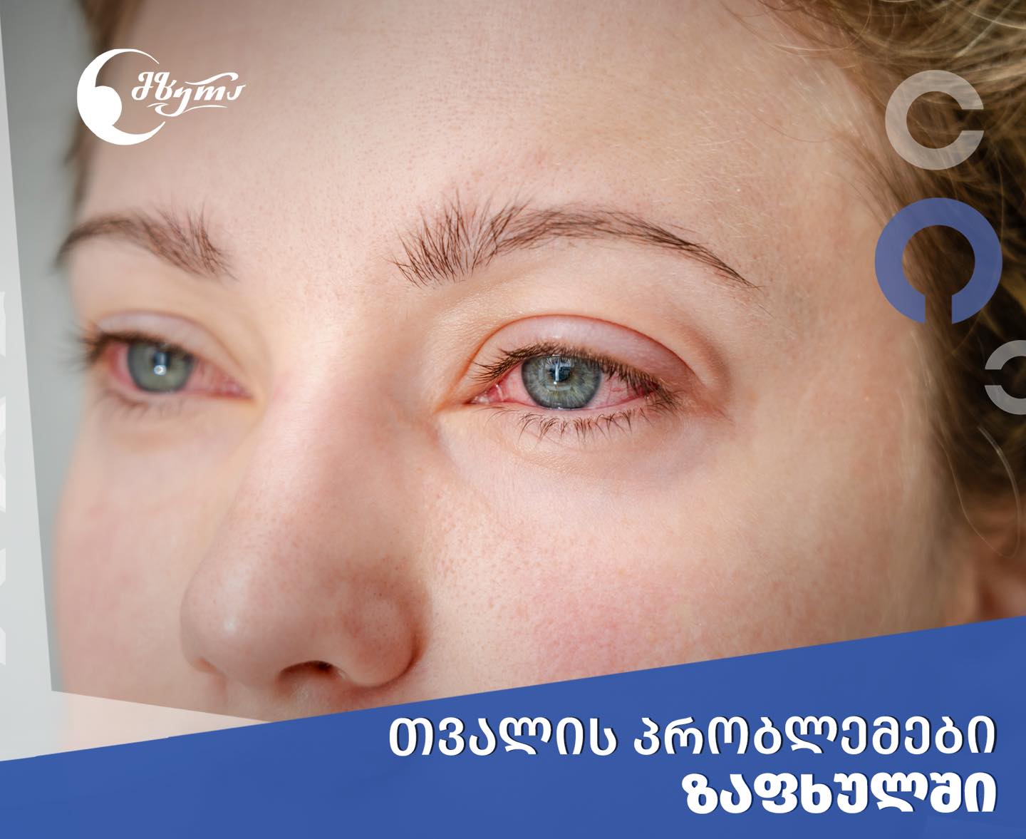 თვალის პრობლემები ზაფხულში